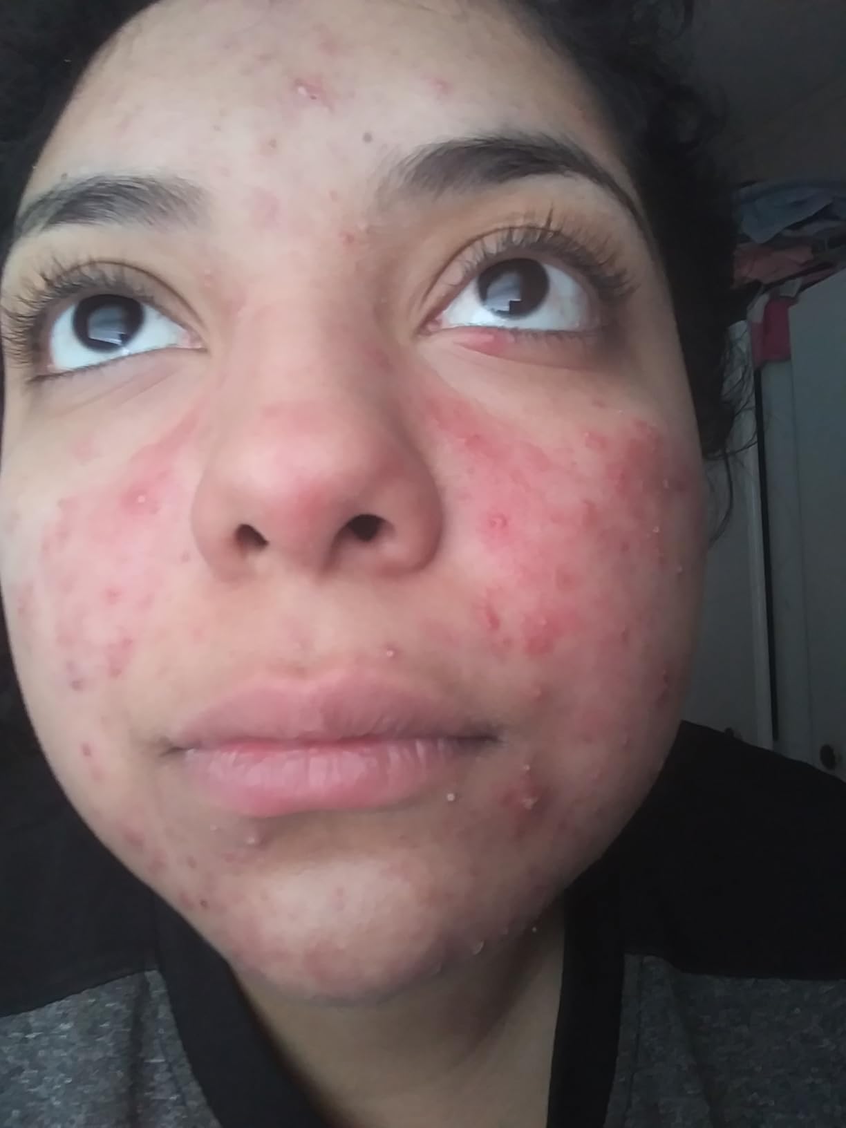 Differin Acne Face Wash with 5% Benzoyl Peroxide, Daily Deep Cleanser by the makers of Differin Gel, Gentle Skin Care for Acne Prone Sensitive Skin, 4 oz (Packaging May Vary) customer photo 2