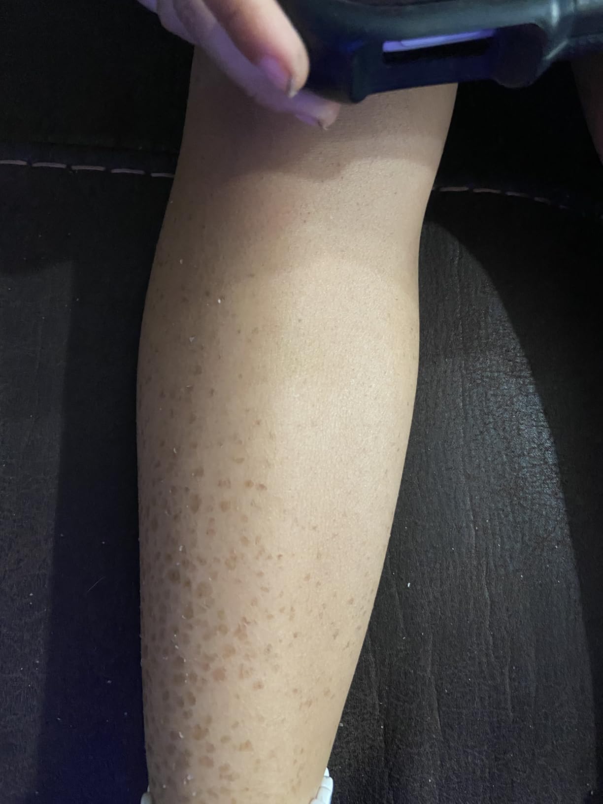 AmLactin Intensive Healing Body Lotion - Therapeutic Lotion for Extremely Dry Skin - No-Scrub Exfoliator and Moisturizer with 15% Lactic Acid AHA and Ceramides, 7.9 oz (Packaging May Vary) customer photo 2