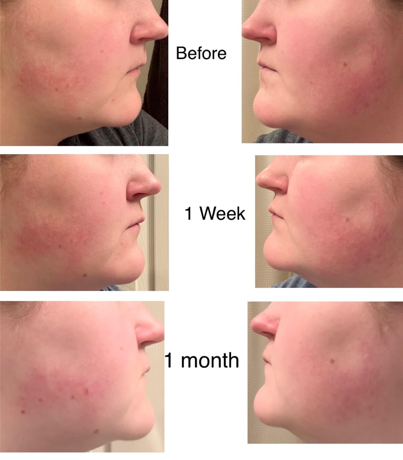 Cos De BAHA Premium Azelaic Acid 10% Serum 1 Fl Oz - Niacinamide & Panthenol Face Serum for Blemish-Prone, Redness-Prone & Oily Skin - Lightweight Aloe-Based Korean Skincare (30 ml) customer photo 1