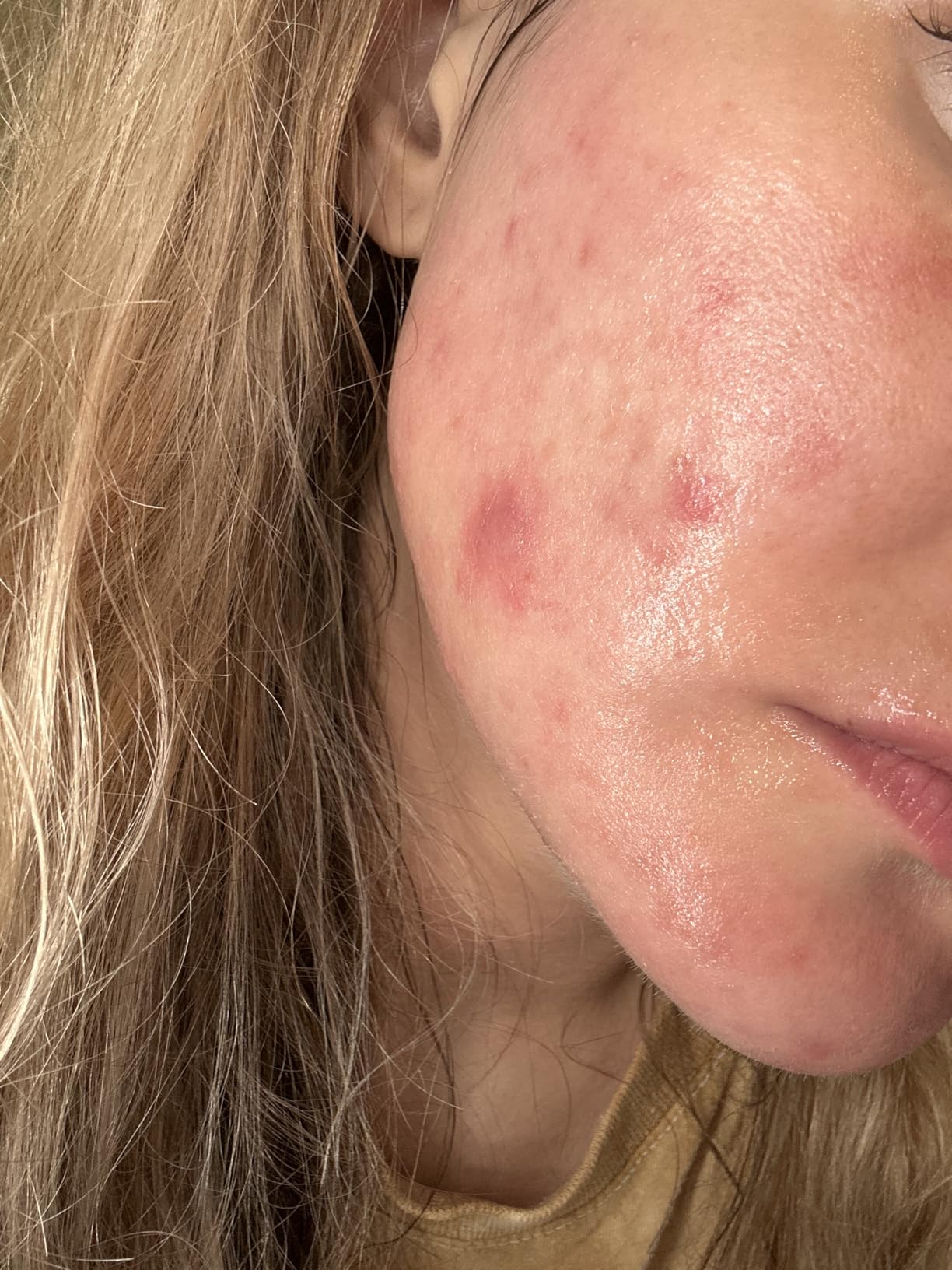 Naturium Azelaic Topical Acid 10%, Face & Skin Care Beauty Treatment with Niacinamide & Vitamin C, 1 oz customer photo 2