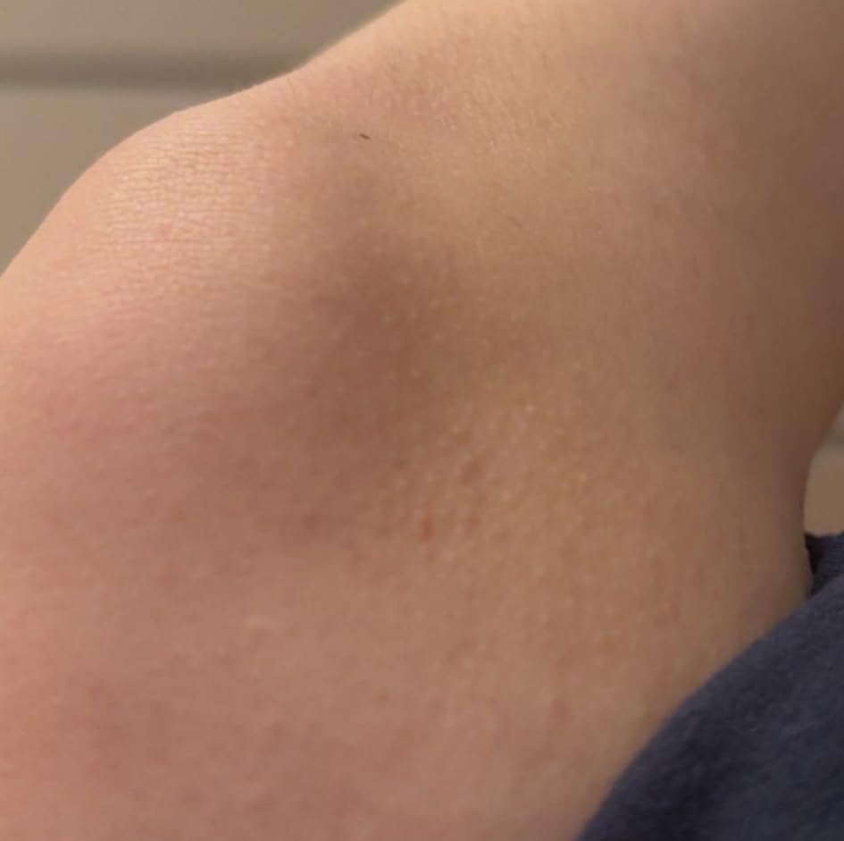AmLactin KP Bumps Be Gone - Therapeutic Body Cream for Keratosis Pilaris - No-Scrub Exfoliator and Body Moisturizer for Dry Skin with 15% Lactic Acid AHA, 3 oz (Packaging May Vary) customer photo 2