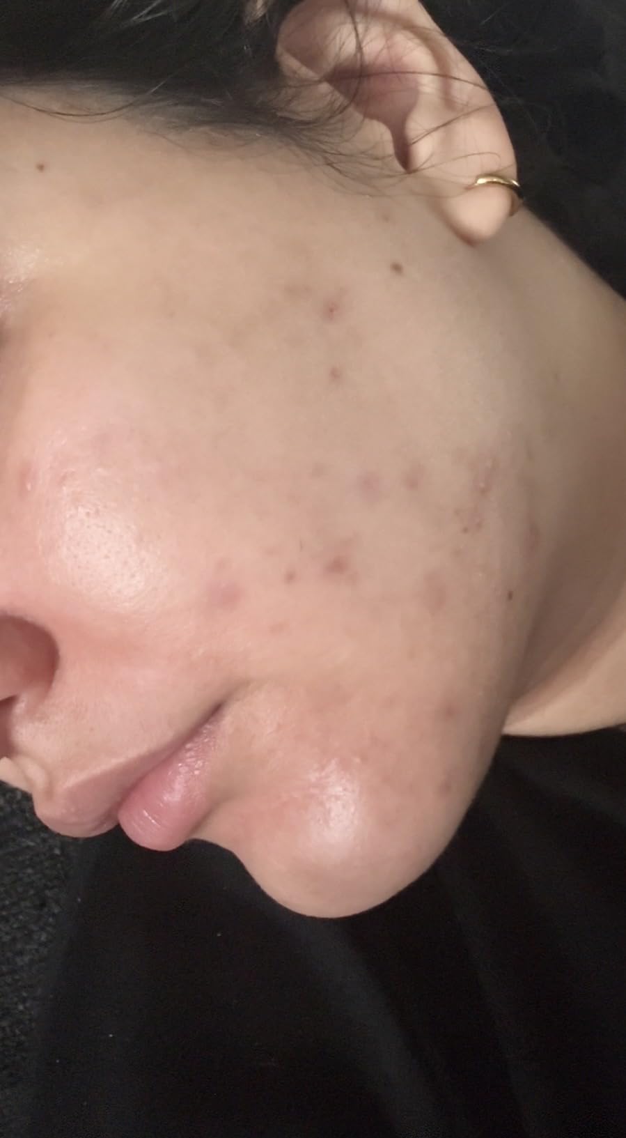 Differin Acne Face Wash with 10% Benzoyl Peroxide, Maximum Strength OTC Acne Foaming Cleanser, Fast Acting Acne Treatment for Face and Body, 5 oz. customer photo 1