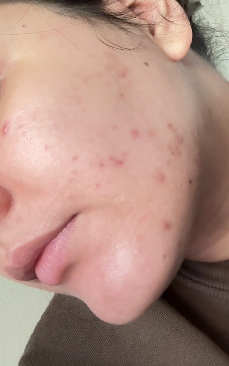 Differin Acne Face Wash with 10% Benzoyl Peroxide, Maximum Strength OTC Acne Foaming Cleanser, Fast Acting Acne Treatment for Face and Body, 5 oz. customer photo 2