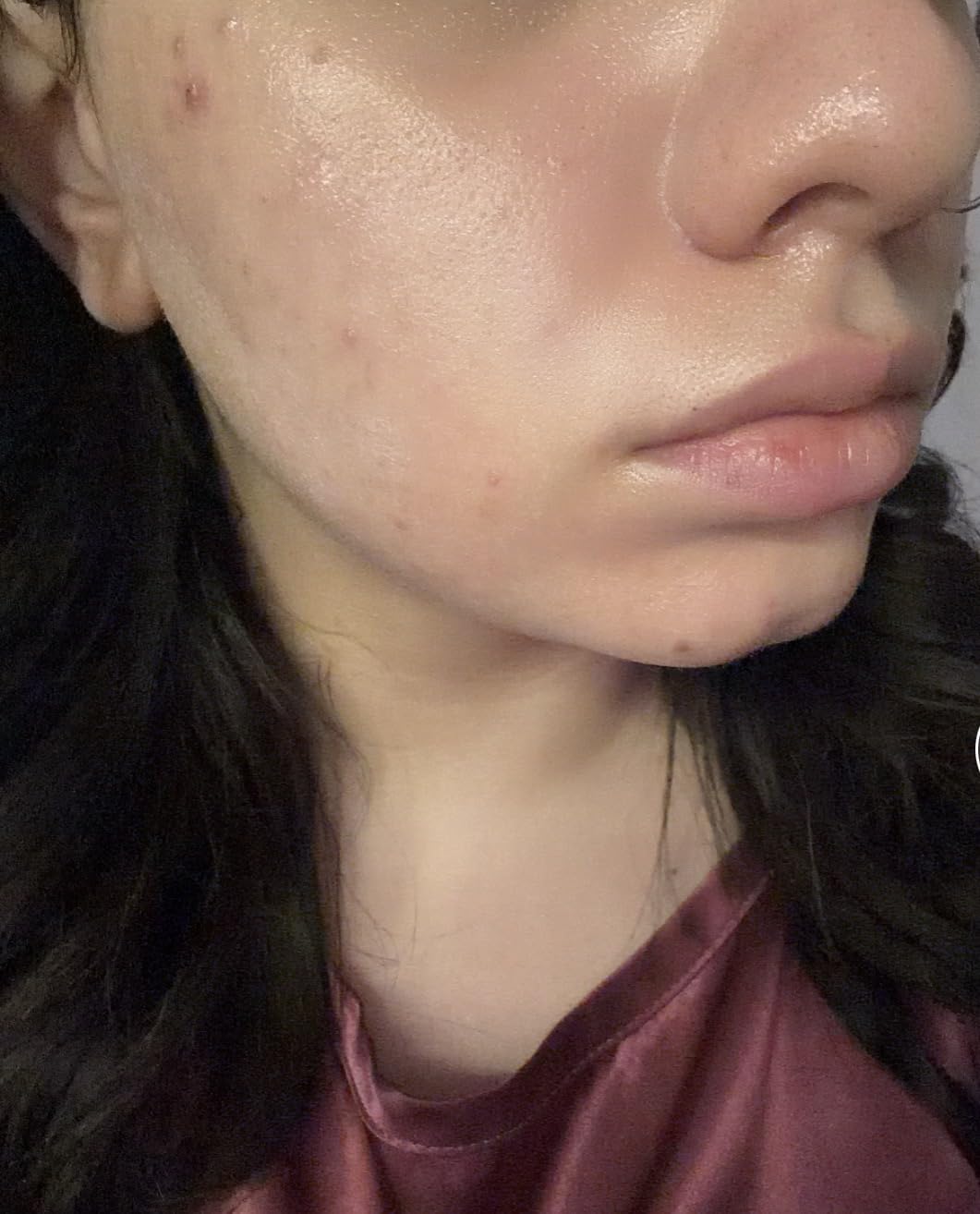 Anua Niacinamide 10 + TXA 4 Serum, Dark Spot Care, Hyaluronic Acid, Tranexamic Acid, Lightweight & Hydrating All-in-One Daily Facial Serum for Glass Skin, Korean Skincare, 1.01 fl.oz customer photo 2