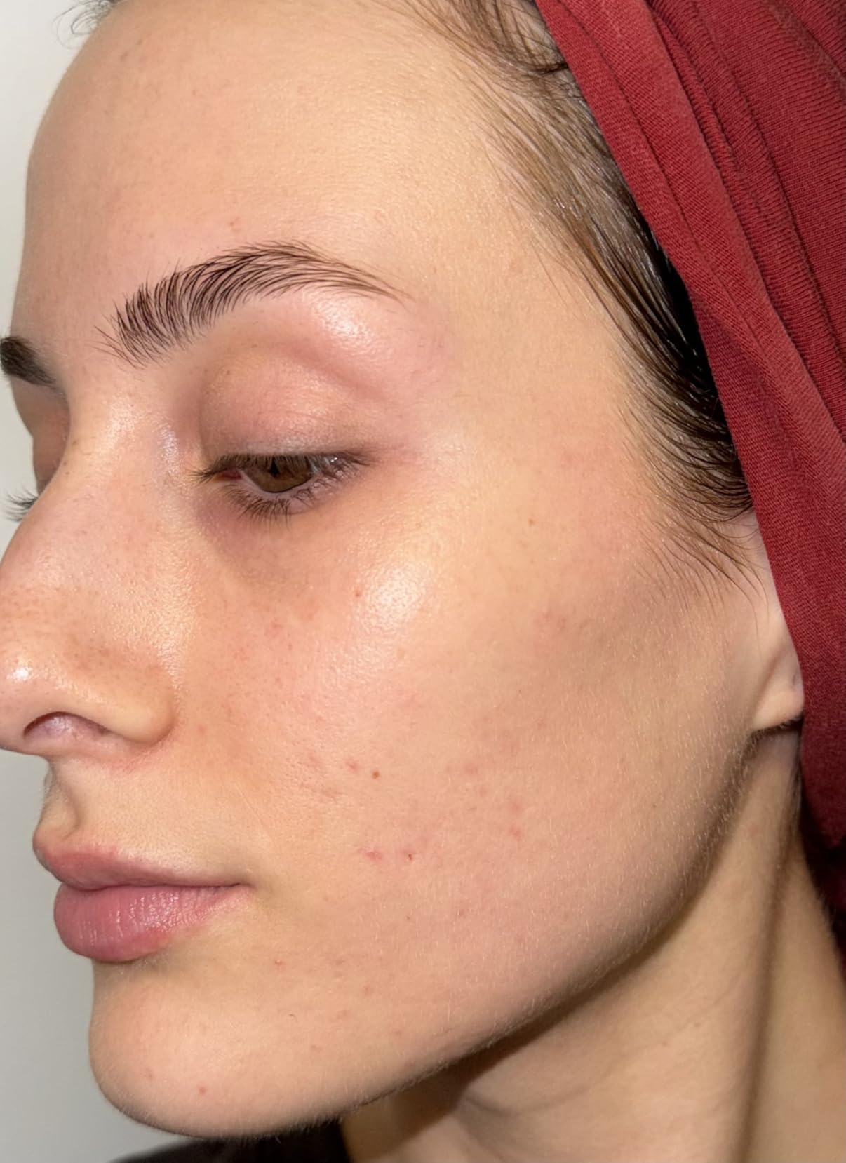 Good Molecules 10% Azelaic Acid Treatment for Face - Soothing Formula for Facial Redness & Uneven Tone - Brightens Dark Spots & Refines Texture - Vegan & Fragrance-Free Skincare (30ml / 1.01 fl oz.) customer photo 2