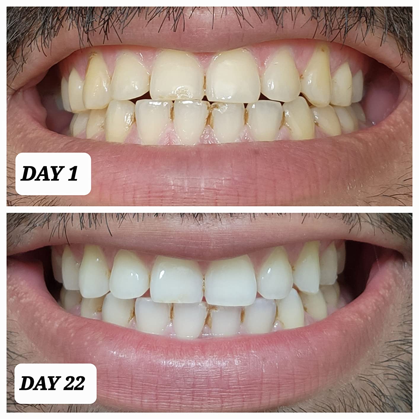 Crest 3D Whitestrips Professional Effects - Teeth Whitening Kit, 22 Treatments (20 + 2 Bonus), Each with 1 Upper/1Lower, 44 Strips - Crest 3DWhite Teeth Whitening Strips customer photo 1