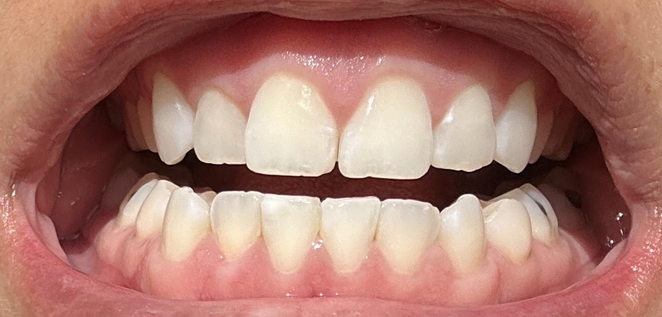Opalescence Go 15- Prefilled Teeth Whitening Trays Kit - 15% Hydrogen Peroxide - (10 Treatments) Dentist Recomended - Made by Ultradent Products. Teeth Whitening Kit -Mint - 5194-1 customer photo 1