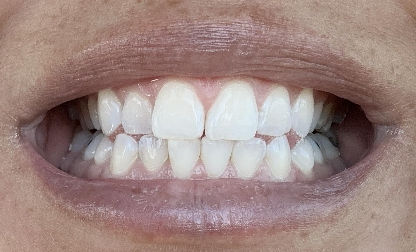Opalescence Go 15- Prefilled Teeth Whitening Trays Kit - 15% Hydrogen Peroxide - (10 Treatments) Dentist Recomended - Made by Ultradent Products. Teeth Whitening Kit -Mint - 5194-1 customer photo 2