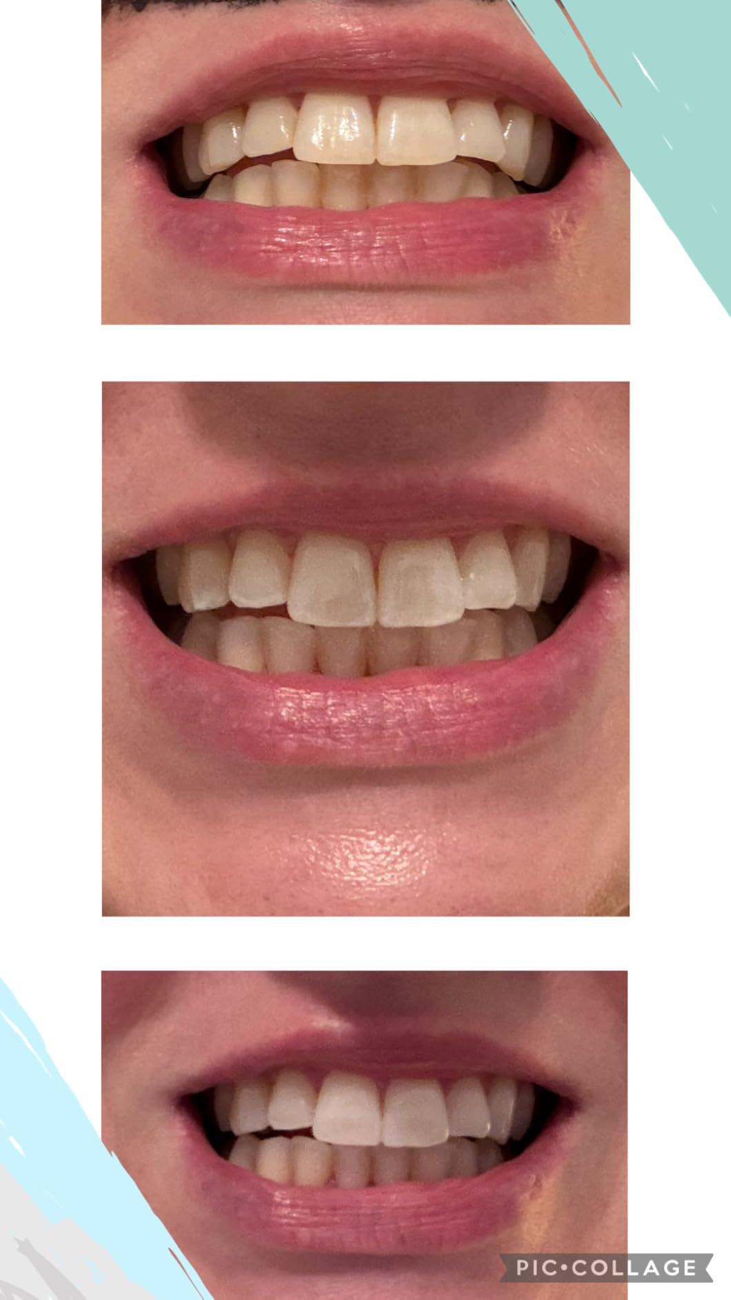 Auraglow Teeth Whitening Kit, LED Accelerator Light, 35% Carbamide Peroxide Teeth Whitening Gel, 20+ Whitening Treatments, Whitens up to 10 Shades in 7 Days customer photo 1