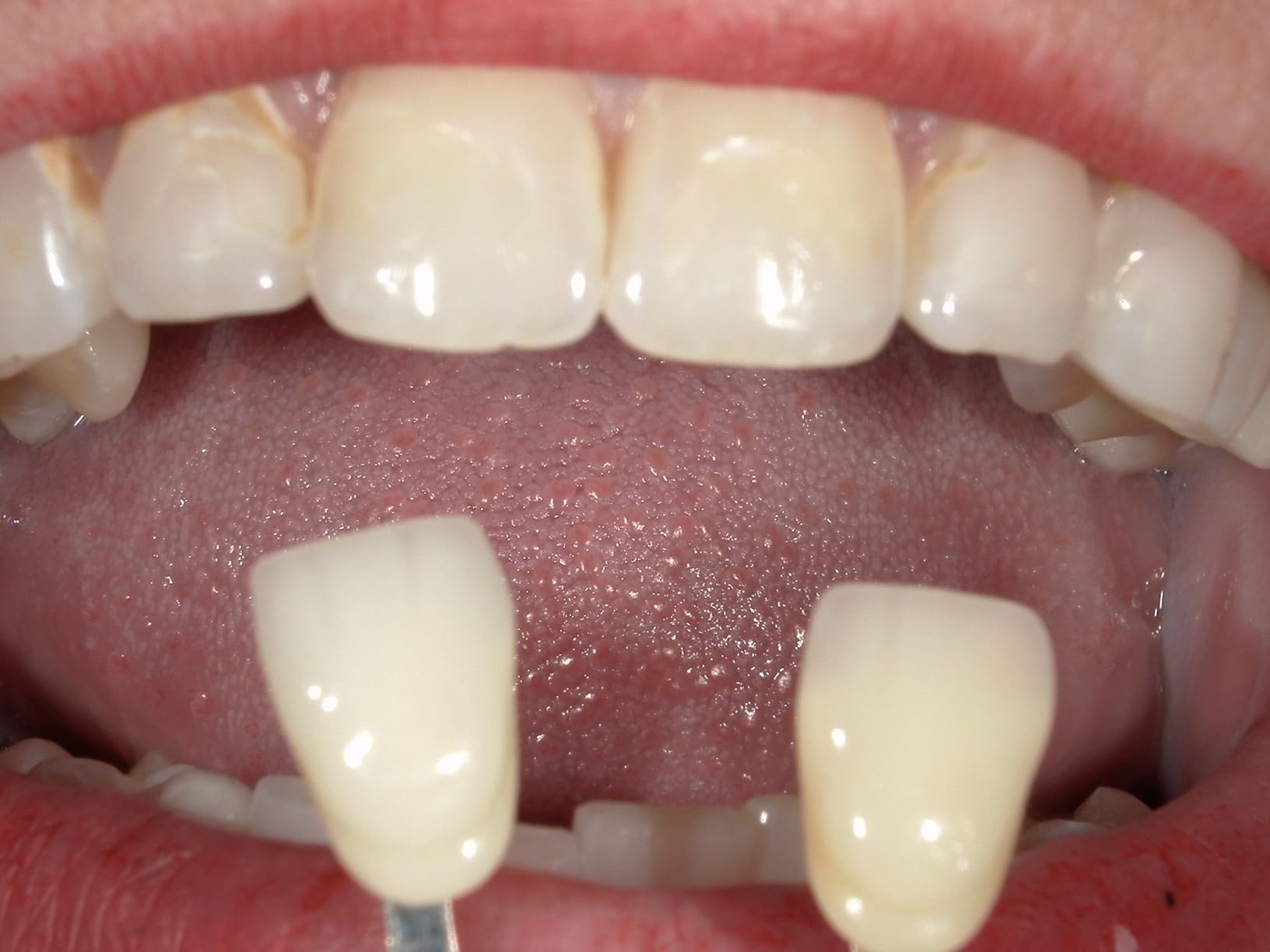 SNOW Diamond Wired Whitening Kit - Sensitive Teeth Whitening, Whitens & Repairs Teeth, 6 Months Treatment customer photo 2