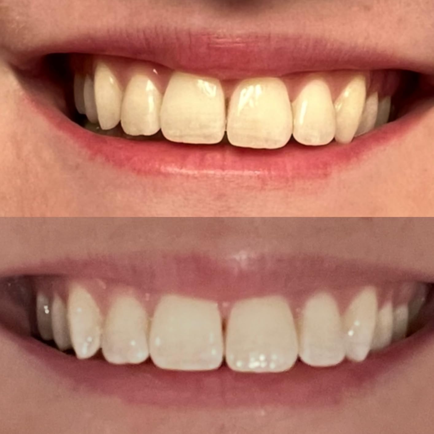 iSmile Teeth Whitening Kit - LED Light, 35% Carbamide Peroxide, (3) 3ml Gel Syringes, (1) Remineralization Gel, and Tray customer photo 2