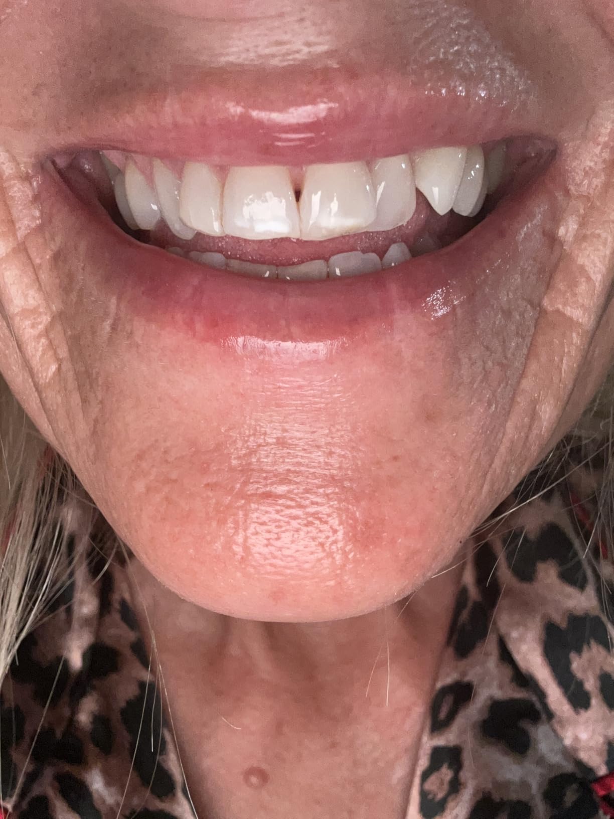 MySmile Teeth Whitening Kit with LED Light, 10 Min Non-Sensitive Fast Whitener with 3 Carbamide Peroxide Gel customer photo 1