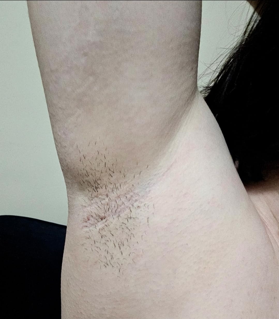 Philips Lumea 8000 Series IPL Hair Removal Device, Permanent Laser Hair Reduction for Women & Men, Easy and Comfortable Use at Home, SenseIQ, 3 Attachments for Body, Face, Intimate, BRI937/03 customer photo 1